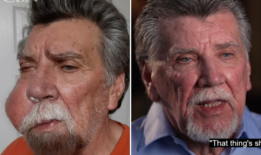 Tumor é dissolvido milagrosamente em rosto de homem: “Deus cura”